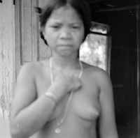 "KT Leprosy ", picture of a shirtless elderly